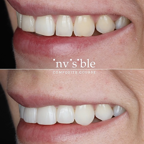 have a break, have a kitkat 🍫 (… and a look at my smilemakeover 🚀🤩✌🏽) bleach & resin for the win 🙃 #invisible #resin...