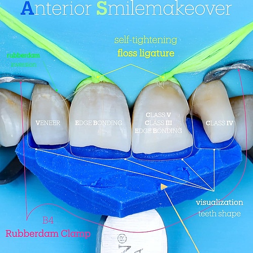 get ready with me: anterior smilemakeover 🎨 #komposit #resin #smilemakeover #veneers #minden #drkoeppen #ästhetik...