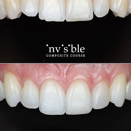 additive dentistry ➕🦷🎨 direct anterior composite restoration #resin #komposit #dentistry #zahnärztin #zahnarzt...
