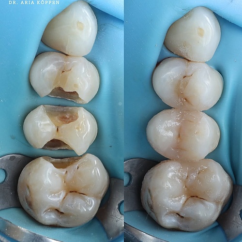 itsy bitsy quadrant rehab #drkoeppen #dentistry #resin #zahnärztin #zahnmedizin #minden #cosmeticdentistry #komposit...