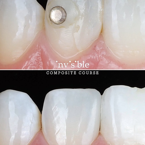 direct diastema closure with resin 💥 #diastema #resin #komposit #füllung #ästhetik #zahnmedizin #zahnärztin #zahnarzt...