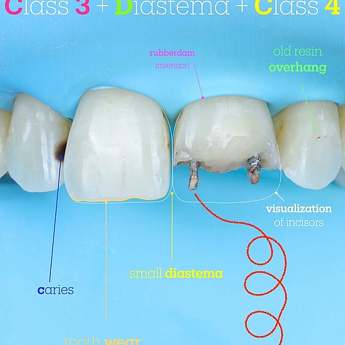 get ready with me 🎨 #resin #class4 #komposit #füllung #smile #biomimetic #cosmeticdentistry #beauty #veneers #minden...