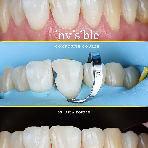 old composite? gone. do we miss it? nope. (do we miss nsync? YES!) #composite #resin #nsyncforever #rubberdam...