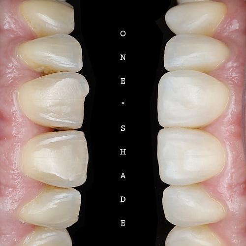 one shade approach with direct resin restorations ✌🏽 #aesthetics #esthetics #veneers #minden #drkoeppen #rubberdam... one shade approach with direct resin restorations ✌🏽 #aesthetics #esthetics #veneers #minden #drkoeppen #rubberdam...