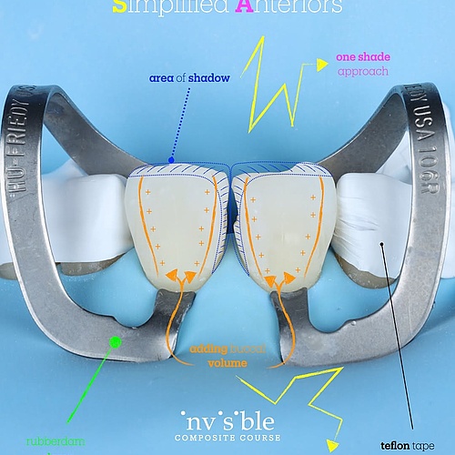 learn how to make resin life easier 🎨 recently learned from dr javier tapia @bio_emulation @gc_germany_ @gc.europe.nv ... learn how to make resin life easier 🎨 recently learned from dr javier tapia @bio_emulation @gc_germany_ @gc.europe.nv ...