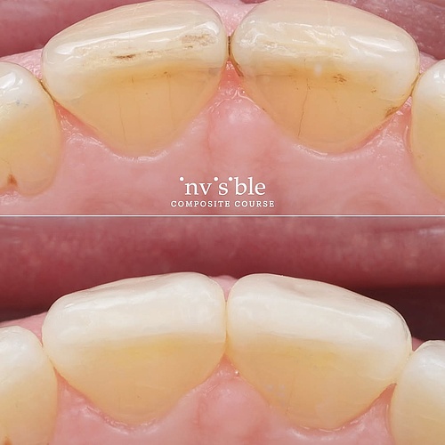 dental rejuvenation ✨ doing less 🚀 additive dentistry ➕ direct composite restoration 🎨 #resin #directrestoration... dental rejuvenation ✨ doing less 🚀 additive dentistry ➕ direct composite restoration 🎨 #resin #directrestoration...