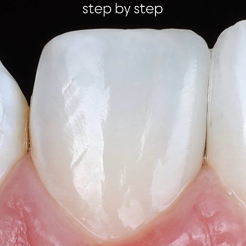 step by step freehand diastema closure 🚀 #komposit #resin #diastemaclosure #directrestoration #biomimeticdentistry...